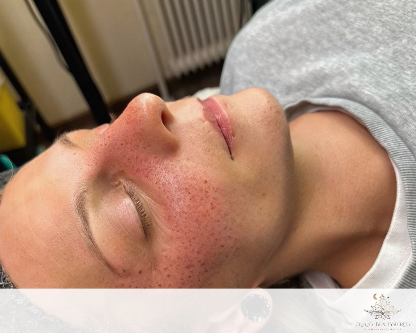 Freckles frisch nach der Behandlung