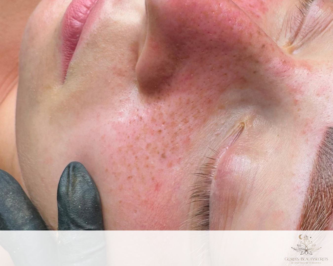 Freckles frisch nach der Behandlung 